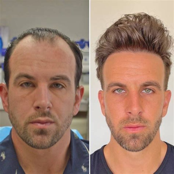 Dan Soder Plastic Surgery: Soder's Decision to Undergo Hair Transplant for Regrowth!